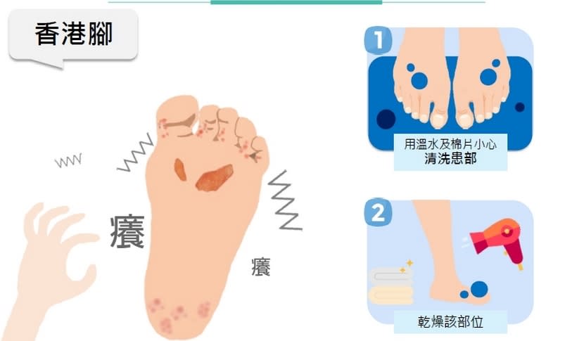 香港腳,藥膏,反覆發作,類固醇