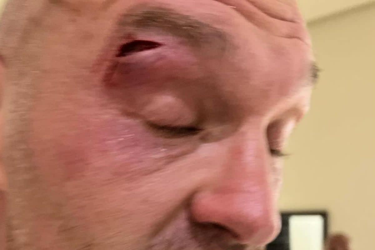 The cut that has ruled Fury out of his fight with Usyk (@QueensberryPromotions via Instagram)