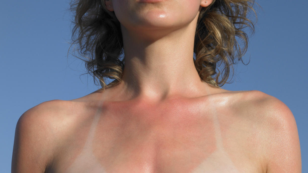 woman with a sunburn