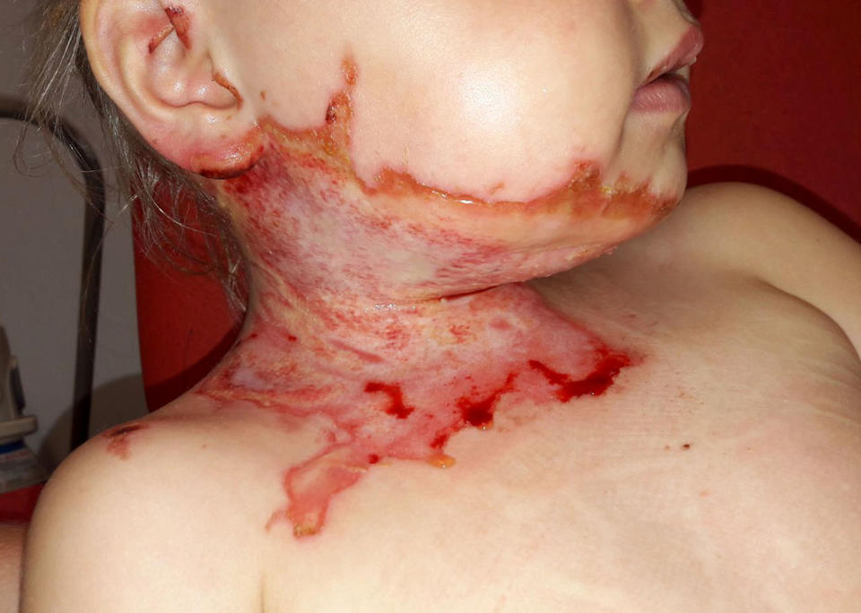 Rosie Mason, 5, was hit by a firework last November, leaving her with horrific burns to the neck. Source: Caters News.