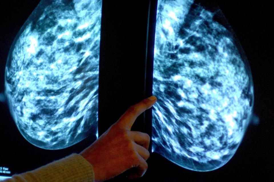 Breast cancer is the most commonly diagnosed cancer in UK women (PA Wire)