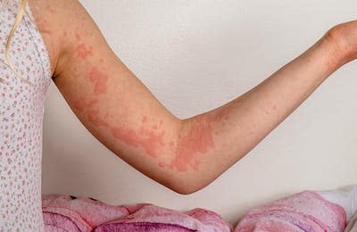 Cold urticaria is more commonly known as hives. <a href="https://www.gettyimages.com/detail/photo/girl-with-urticaria-royalty-free-image/1389641807?phrase=hives&adppopup=true" rel="nofollow noopener" target="_blank" data-ylk="slk:Elk Scott/i Stock via Getty Images;elm:context_link;itc:0;sec:content-canvas" class="link ">Elk Scott/i Stock via Getty Images</a>