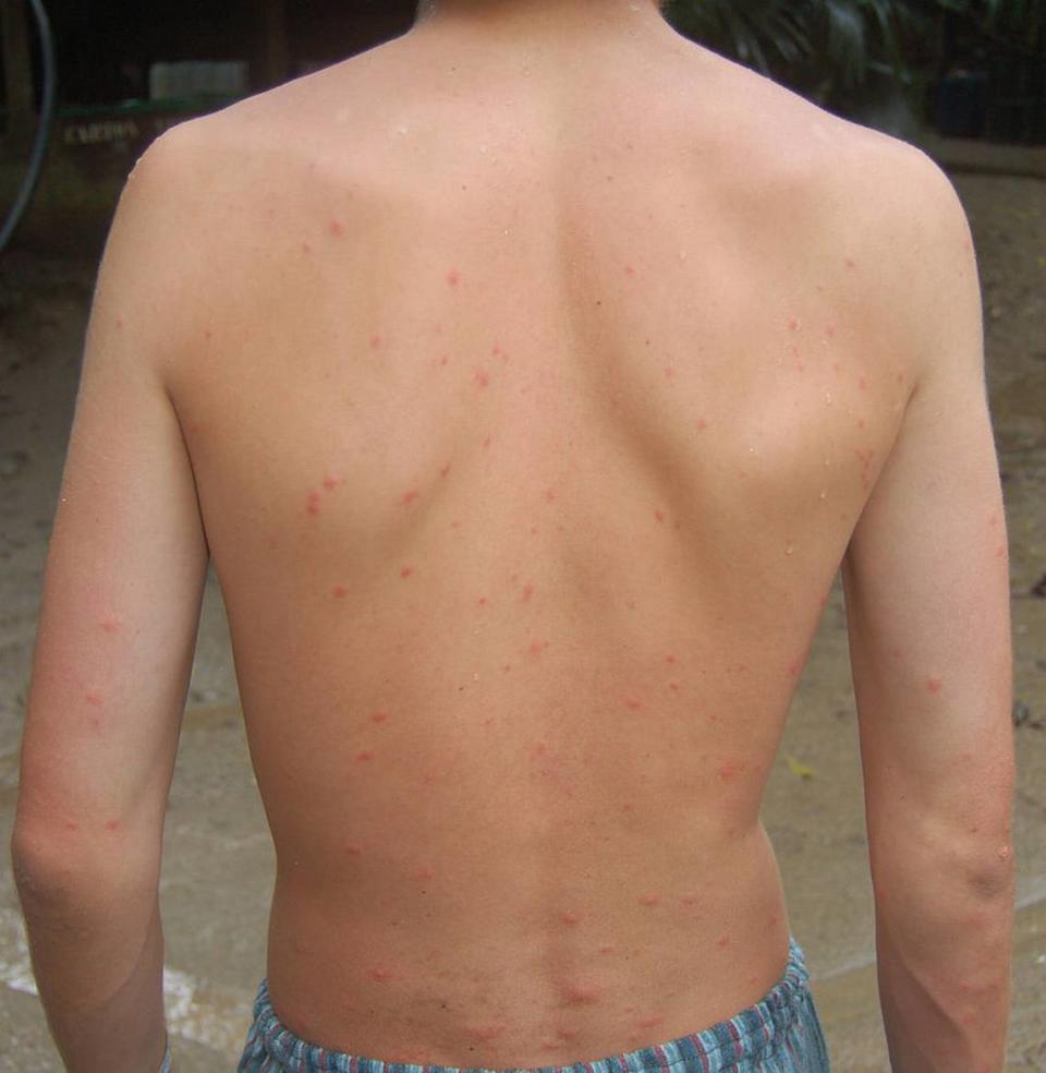 An inidividual displays mosquito bites on the back in this Wikimedia Commons photo.