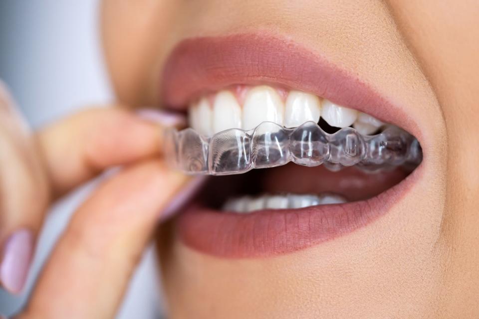 <p>Getty</p> Clear aligner dental night guard for teeth