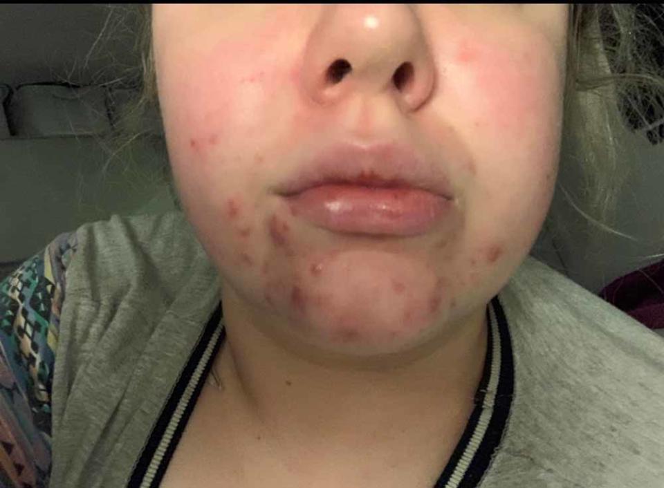 Emma struggled with acne for seven years. (Collect/PA Real Life)
