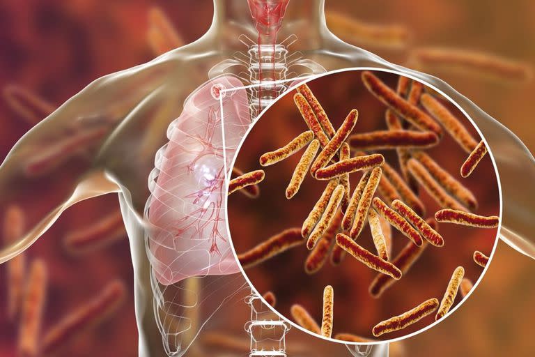 Pese a la falsa creencia sobre la erradicación de la tuberculosis, todos los años se informan contagios y muertes por la enfermedad