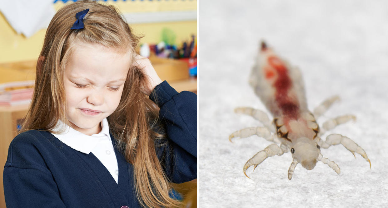 Nits: Head lice are a common problem when children go back to school. [Photo: Getty]