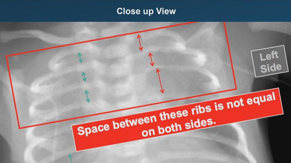 This X-Ray of Tristan's lungs show the space between his ribs is not equal on both sides.