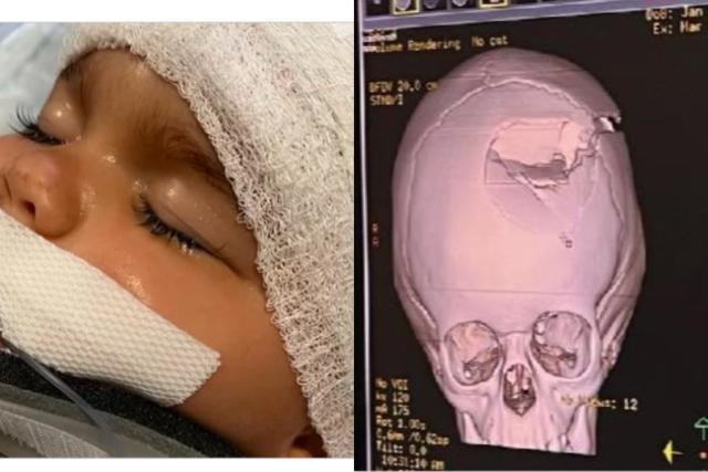 Niño en San Diego sufre fractura masiva de cráneo tras patada de caballo
