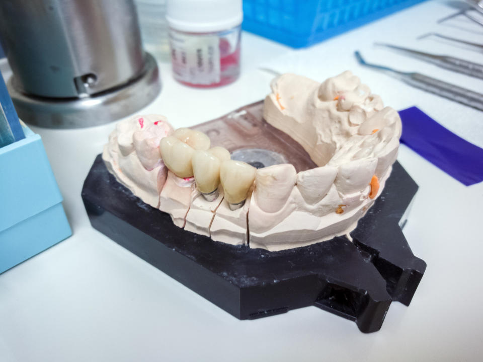 A molding of teeth