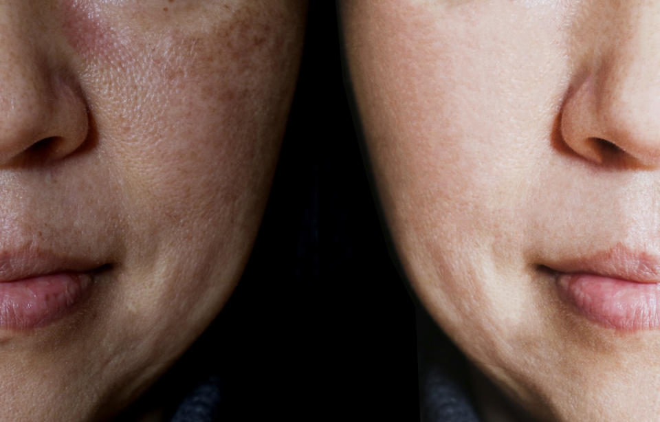 Melasma most commonly appears on the forehead, upper lip and cheeks, and women are more prone to the condition than men. The photo on the left is without makeup, and the photo on the right is with makeup. (Photo: CarlaNichiata via Getty Images)