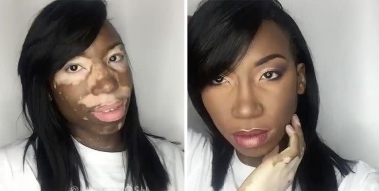 L’incroyable transformation maquillage de Carlene John, mannequin atteint de vitiligo. (Photo : Instagram/@khloedash)