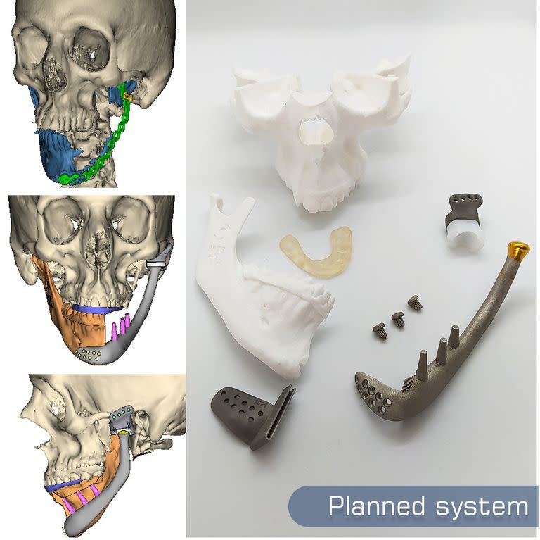 Las prótesis se realizan en base a imágenes de tomografías.
