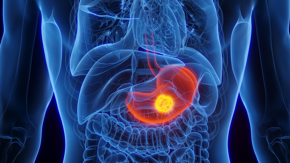 Stomach cancer is more common in men than women. (Image via Getty Images)
