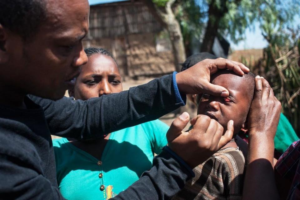 Muluadam Abraham, an ophthalmic nurse, examines a small child for signs of trachoma, finding white spots on the inside of the eyelid that indicate infection. (Photo: Tom Gardner)