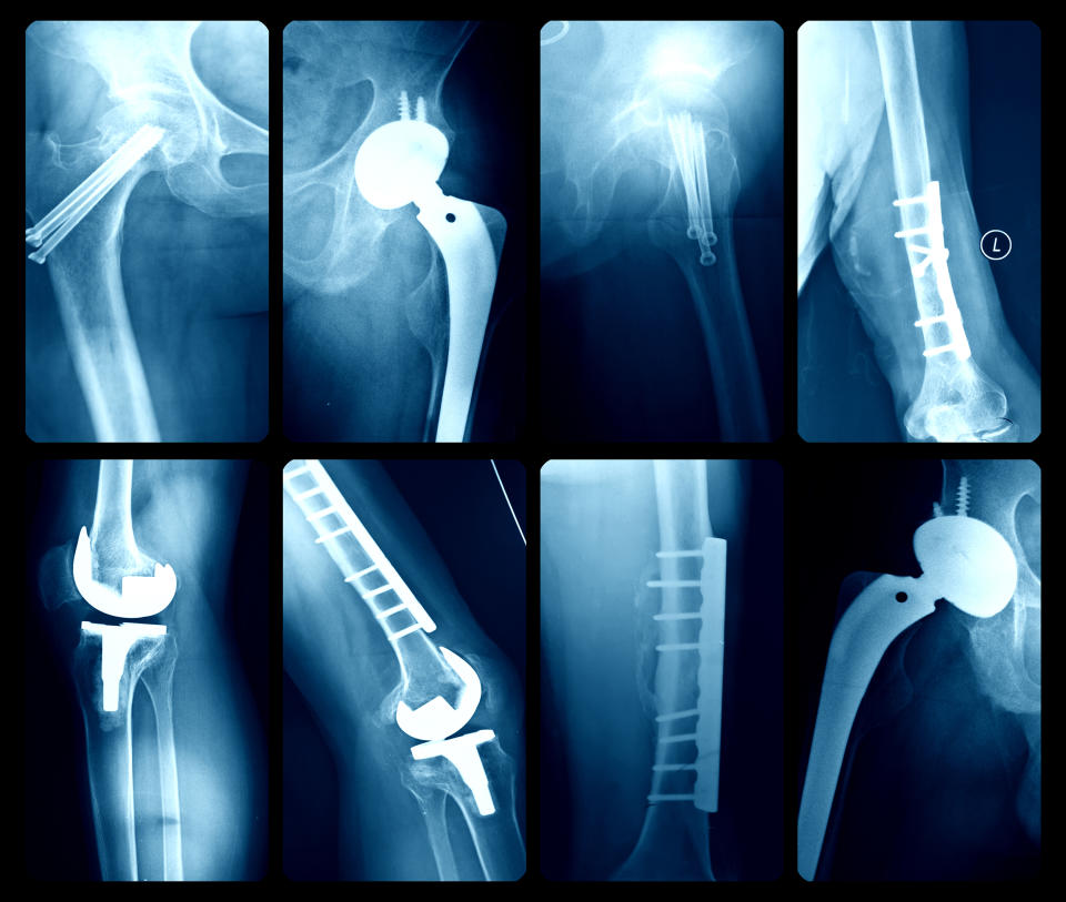 X-ray illustration of artificial joints (real444 / Getty Images)