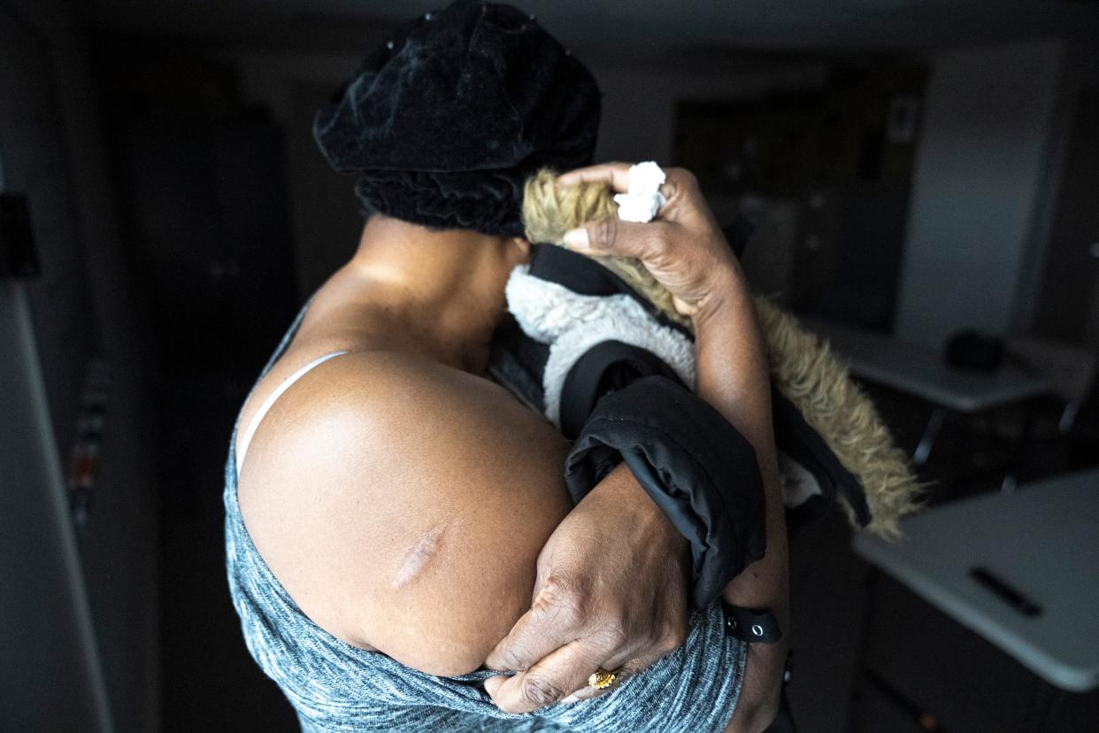 A 45-year-old Mauritanian woman seeking asylum shows a scar on her arm from when she was beaten by officials in her country and jailed due to her political viewpoints. She now lives on Columbus' East Side and is seeking asylum to stay in this country, as she fears death if she's sent back to her home country.