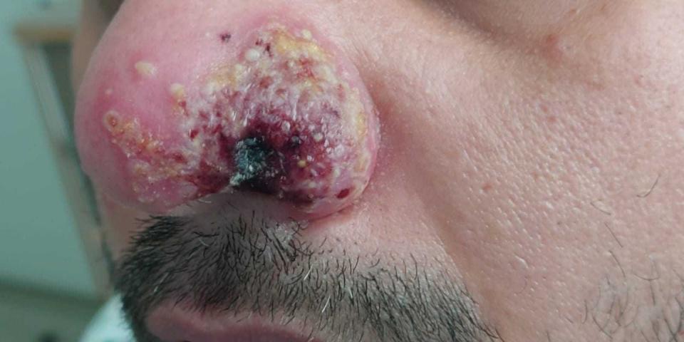 Tulunay's infected nose with raised yellow bumps around a discolored hole