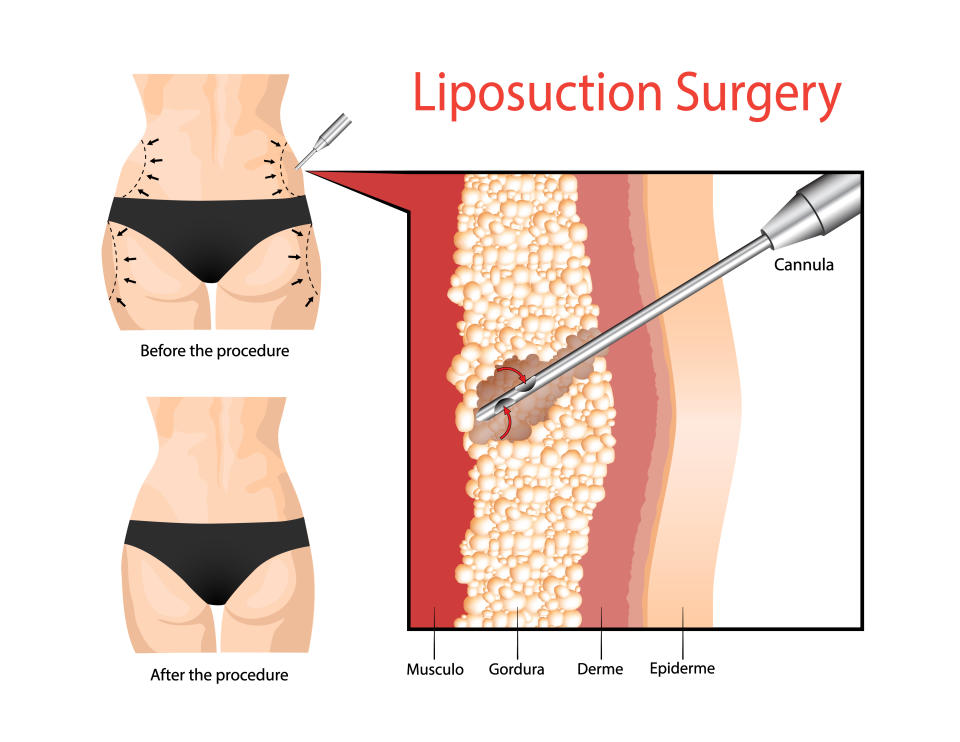 Liposuction uses a suction to remove fat cells from a specific area, resulting in shape changes that are typically permanent. (Photo via Getty Images)