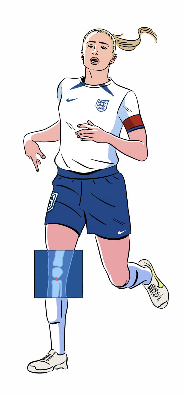 Por qué hay tantas lesiones de rodilla en el fútbol femenino? Te