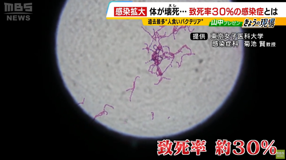 遊日小心！日本「食人菌」病例破紀錄 死亡率高達3-5成！一覽感染病徵、預防措施、病例暴增原因