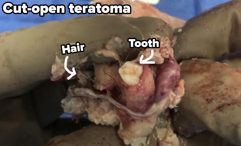 teratoma with teeth and hair