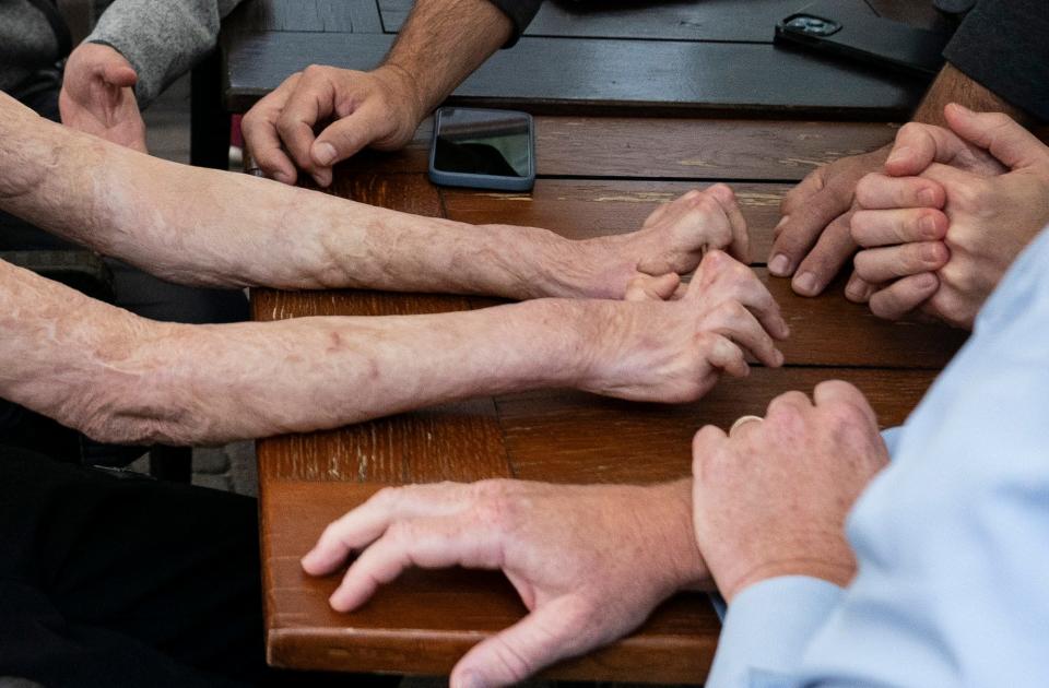 Karolina Petrenko,16, of Cherkasy, Ukraine reaches her arms out for her burn scared hands to be assessed on Sunday, May 14, 2023 at her hotel in Leczna, Poland by Doctors Collaborating to Help Children before surgery to help correct and release her fingers.