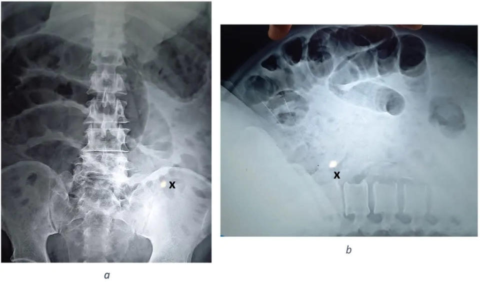 Exames de imagem mostrando a perfuração no intestino do homem, que faleceu 8 após a admissão no hospital (Imagem: Munasinghe et al./IJSCR)