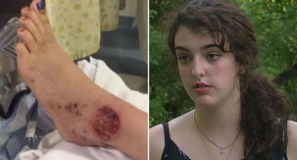 Kayley Coletta, 16, contracted a flesh-eating bacteria while canoeing the Little Miami River in Ohio last month. Source: Fox 19