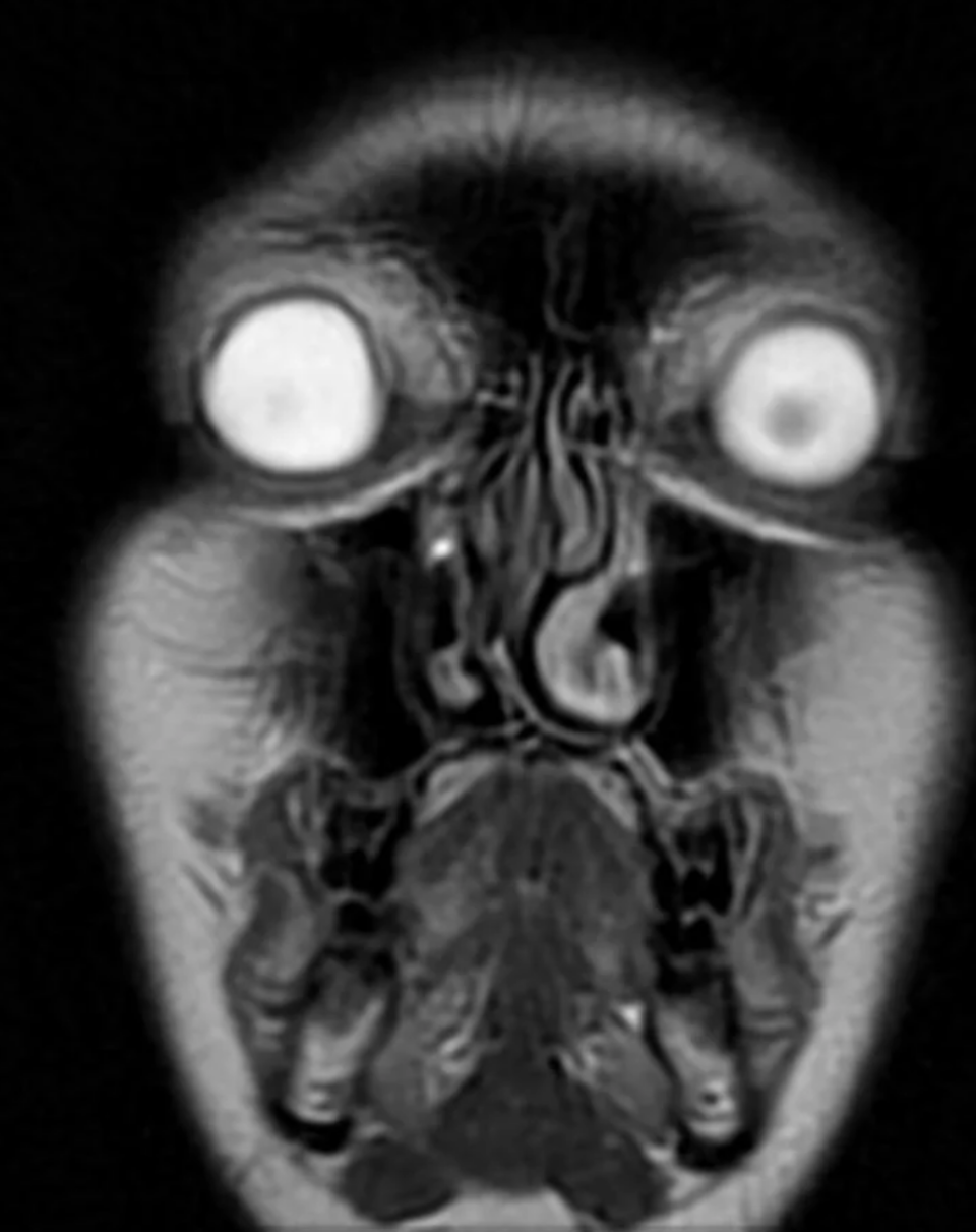 MRI scan showing a cross-sectional view of a human head, primarily focusing on the brain and eyes