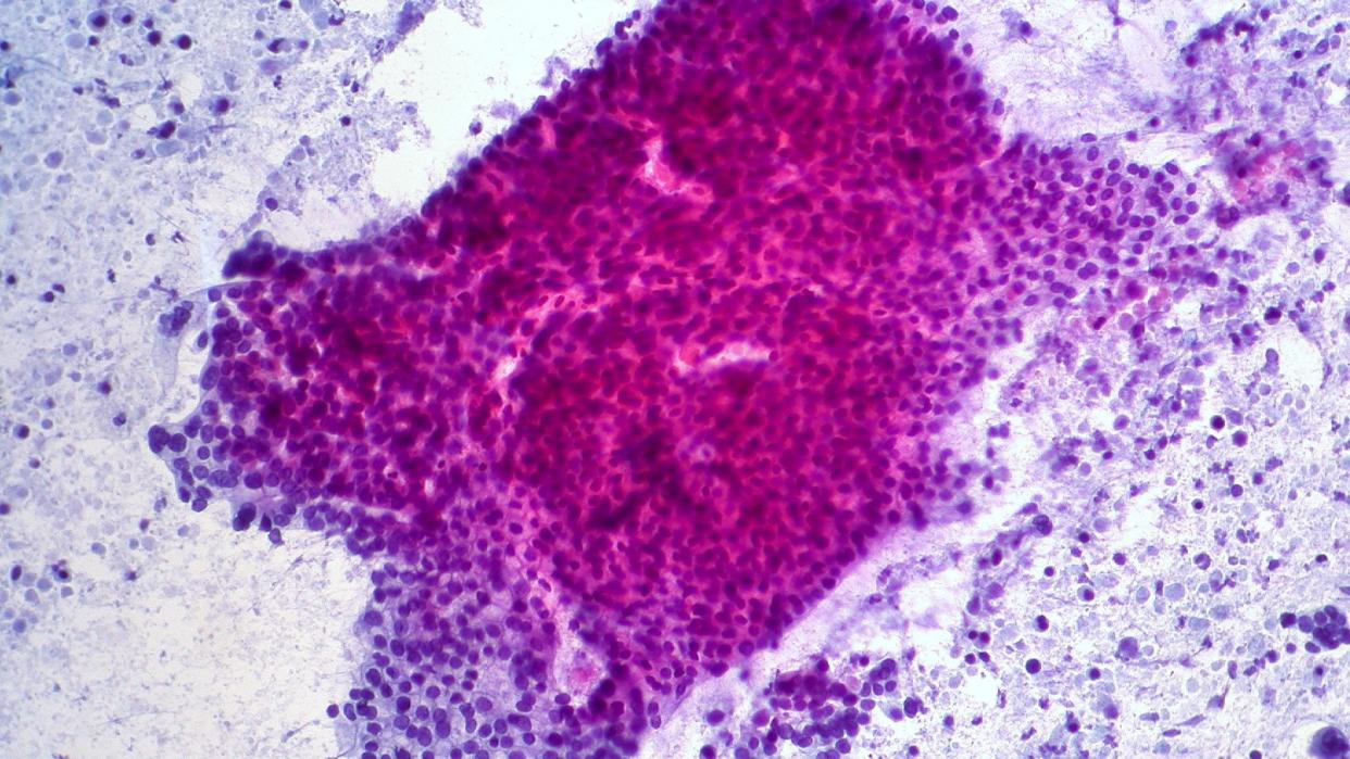  Microscope image of an adenocarcinoma in the pancreas. Cancer cells can be seen in dark pink and purple concentrated in a blob in the center of the image. Normal cells can be seen in purple dotted about around it with white gaps in the image where no cells are present. . 