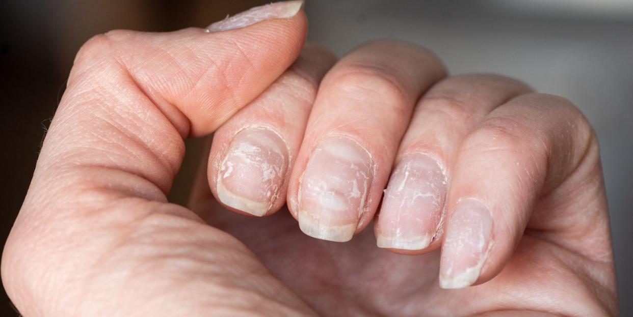 close up of brittle nails