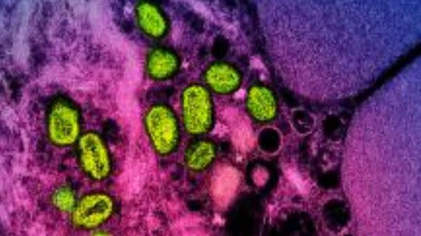 PHOTO: This undated image obtained from the National Institute of Allergy and Infectious Diseases (NIAID) in Bethesda, Md., shows a colorized transmission electron micrograph of monkeypox particles.  (National Institute of Allergy an/AFP via Getty Images)