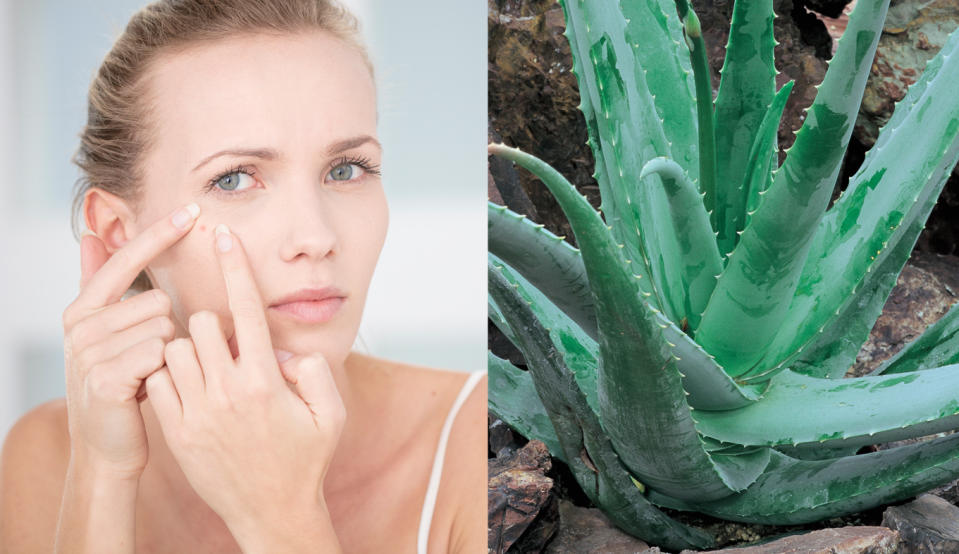 <p>Dank seiner entzündungshemmenden und antibakteriellen Wirkung, ist Aloe Vera ein natürliches Mittel gegen Pickel. Dafür einem Blatt das enthaltene Gel entnehmen, auf die betroffene Stelle auftragen und 10 bis 15 Minuten wirken lassen. Anschließend ausspülen und die Anwendung eine Woche lang zweimal täglich wiederholen. (Bild: Getty Images) </p>