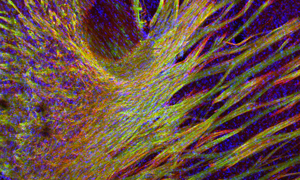 Just like the electrical wires in the national grid, the electrical connections between brain cells, as shown in this picture, have to be well insulated. If this insulation is lost, neurons lose their ability to communicate efficiently. This is what happens in several neurological diseases including multiple sclerosis (MS).