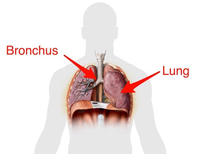 A schematic shows where the bronchus and lungs are on a cross-section of a person