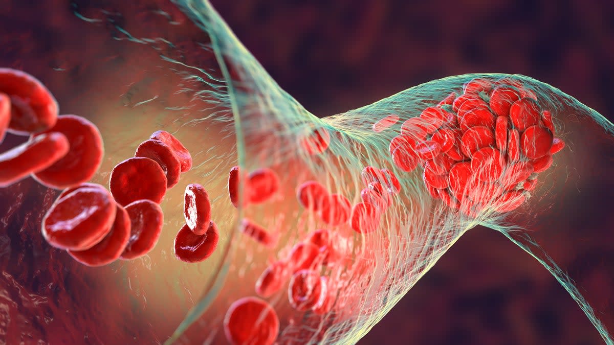 Blood clot made of red blood cells, platelets and fibrin protein strands. Thrombus, 3D illustration (Getty Images/iStockphoto)