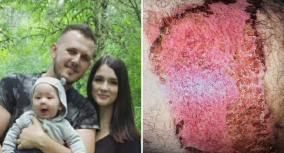 Pictured left is Tommy Piluyev and his wife Liudmila Maftey. Right is a picture of a large burn on a thigh. Source: CBS Sacramento