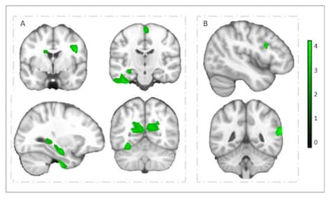 Researchers saw noticeable growth in several areas of the brain  - Credit: University of Granada 