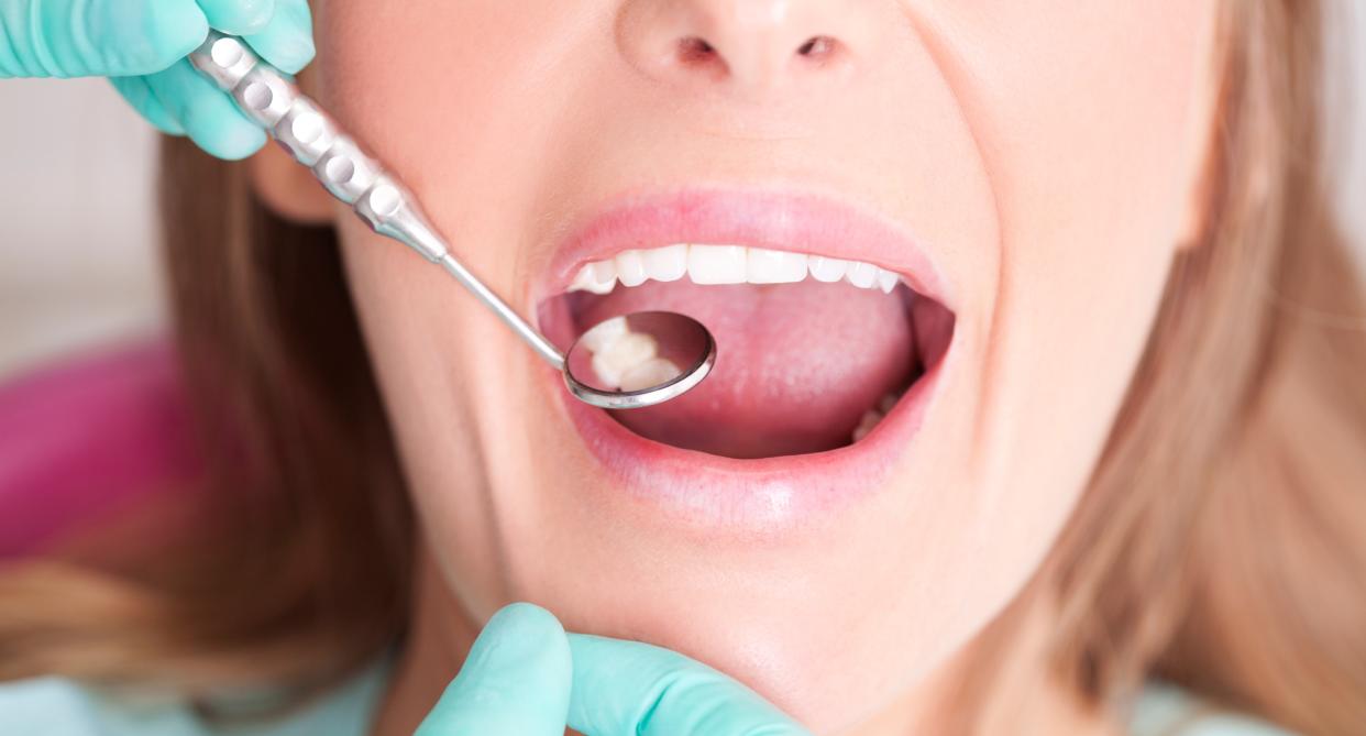 Woman undergoes dental procedure as the 'Turkey teeth' trends is seeing Brits travel abroad in a bid to get straighter, whiter teeth. (Getty Images)