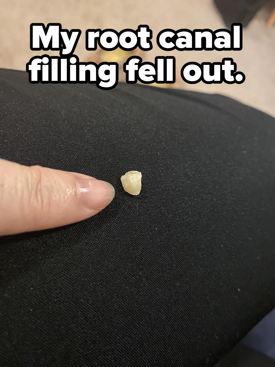 Person showing a piece of a tooth on a surface, with caption "My root canal filling fell out"