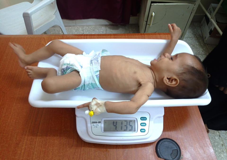 A malnourished boy is placed on a scale at the Hays Rural Hospital in Hodeida, Yemen, Tuesday, Oct. 11, 2022. For years starvation has been an everyday threat for Yemen’s children. Now, as the war threatens to escalate between the country’s warring parties after months of a tenuous truce, there are fears that it could get worse. (AP Photo/Hussam Al-Bakry)