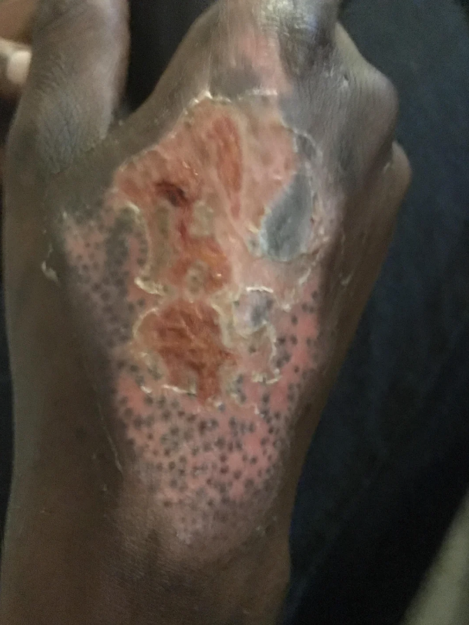 Close-up of a person's foot with a healing wound and dotted skin pattern, possibly from a medical condition or treatment