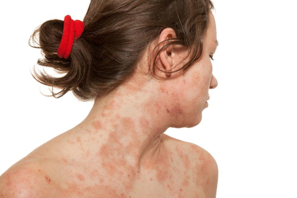 rosacea atopic dermatitis identification picture