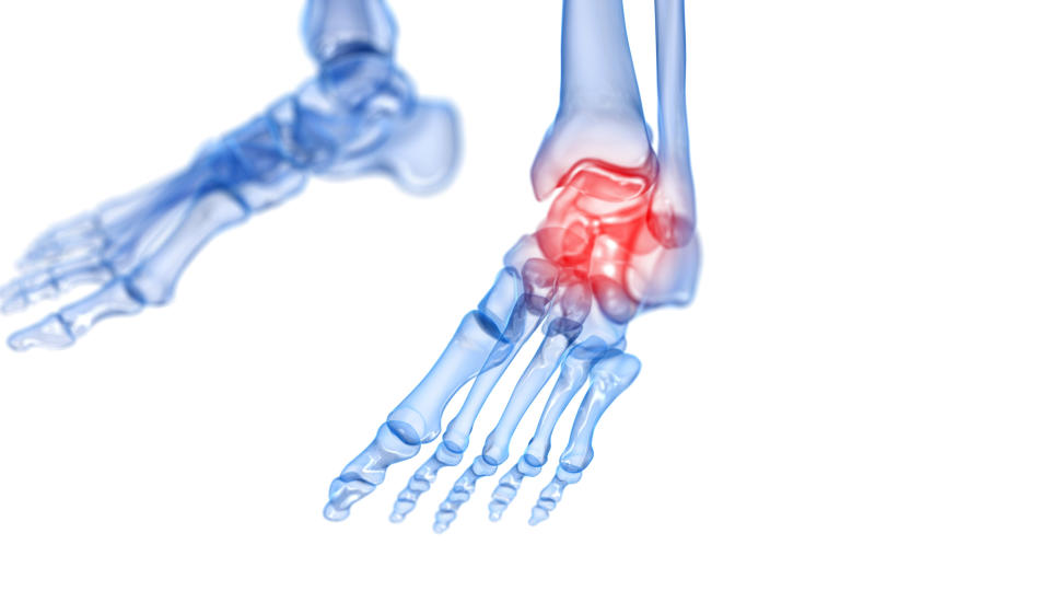 A red light over an X-ray of a skeletal foot