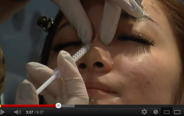 Print screen of a young Singaporean blogger receiving nose fillers (YouYube screengrab)