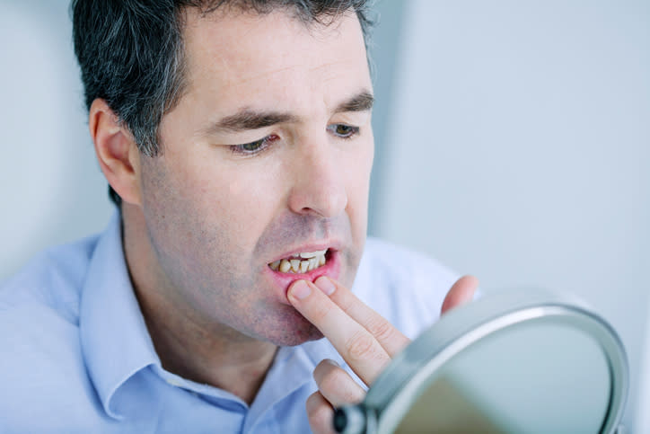 La bacteria que causa la periodontitis sería capaz de ocasionar ciertos tipos de cáncer. Foto: BSIP/UIG/Getty Images