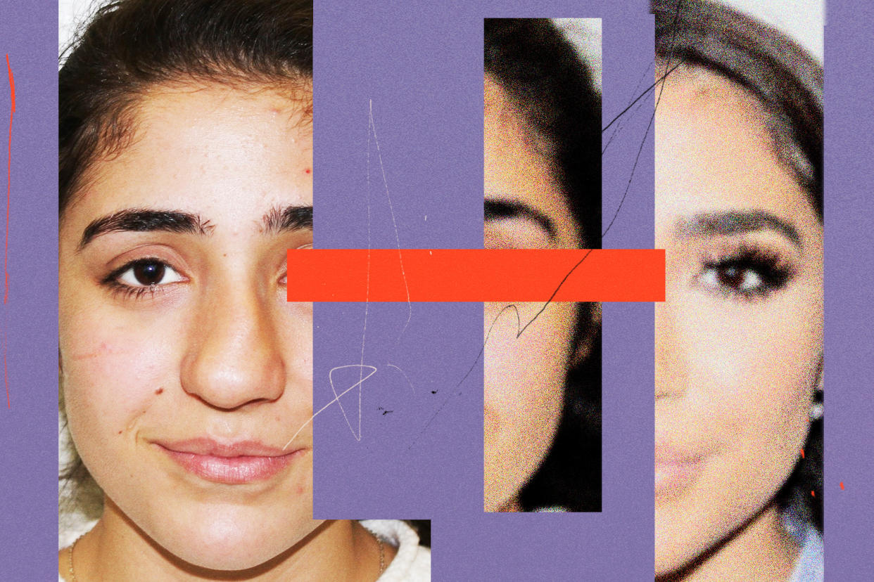 Certain before and after photos of plastic surgery patients may be too good to be true, according to doctors. (Photo illustration: Alex Cochran for Yahoo News; photo: @medistanbultr via Instagram)
