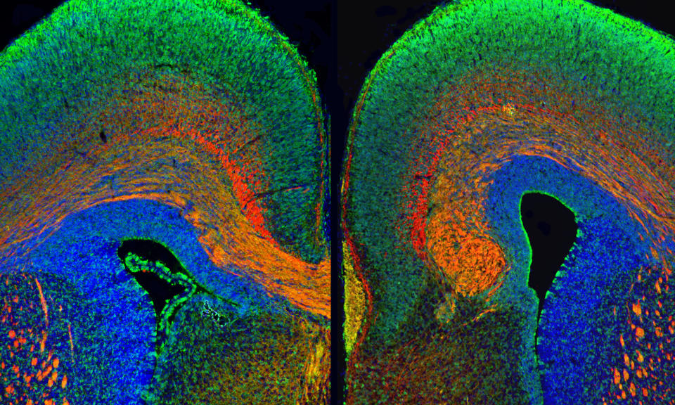 This image shows differences between a typical brain (left) and autism (right). The different colors identify different areas of the brain.    