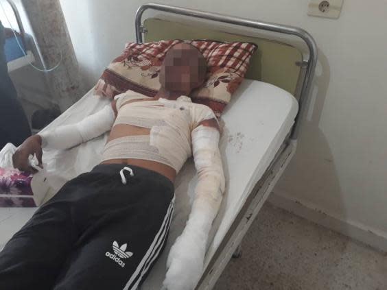 A severly burnt young man treated in Hasakah (Kurdish Red Crescent )